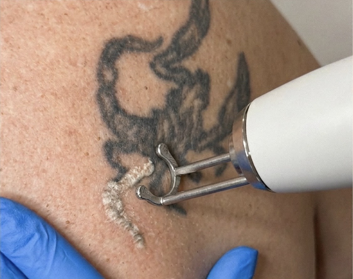 Odstránenie tetovania — Quanta EVO Nd:YAG laser