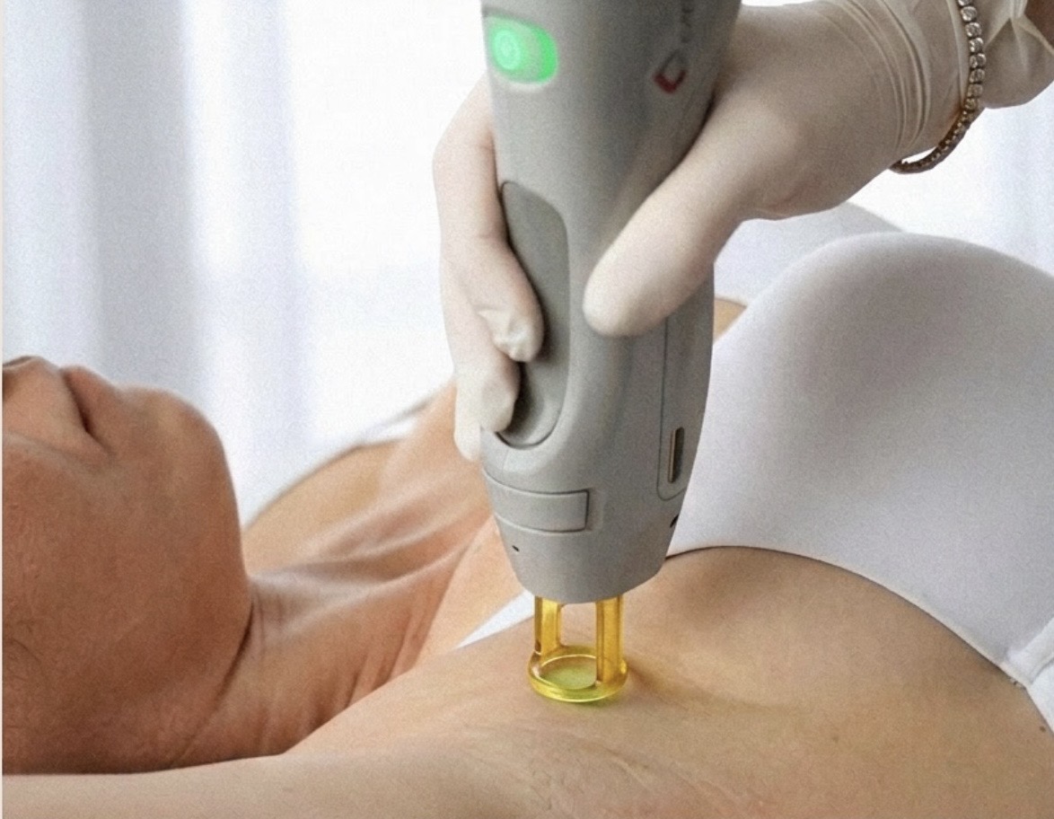 Laserová epilácia — Alexandritový laser Candela